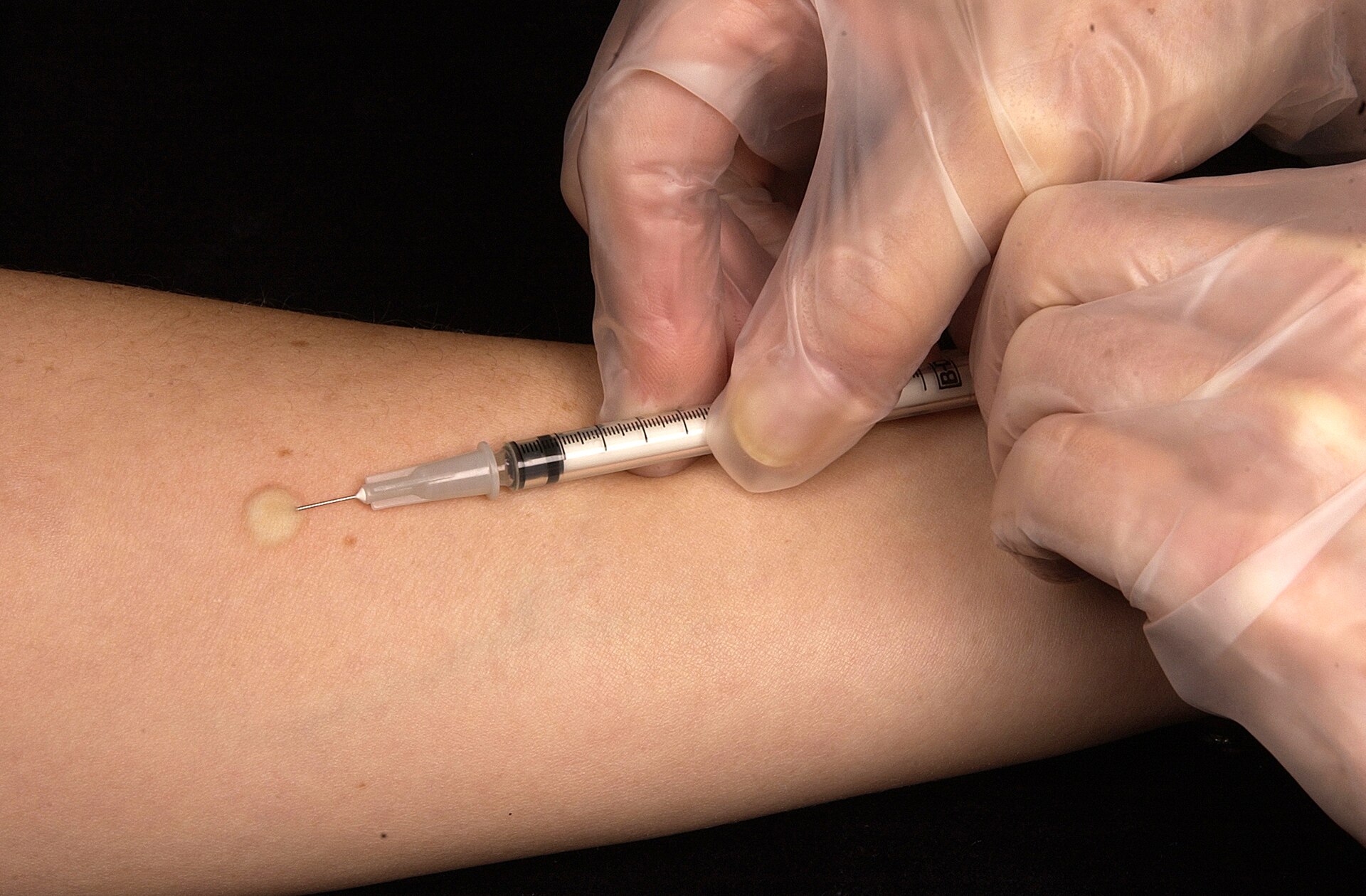 Mantoux tuberculin skin test being administered on a forearm