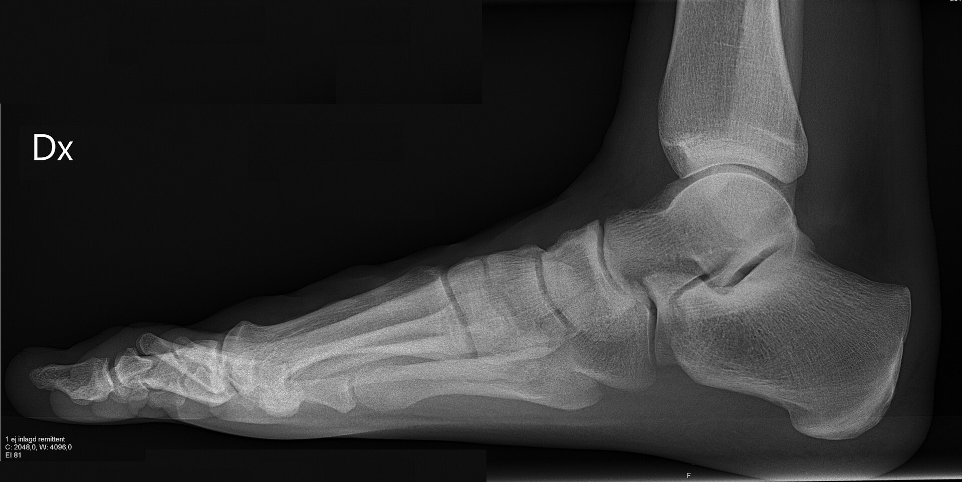 X-ray radiograph showing the bones of a foot and ankle